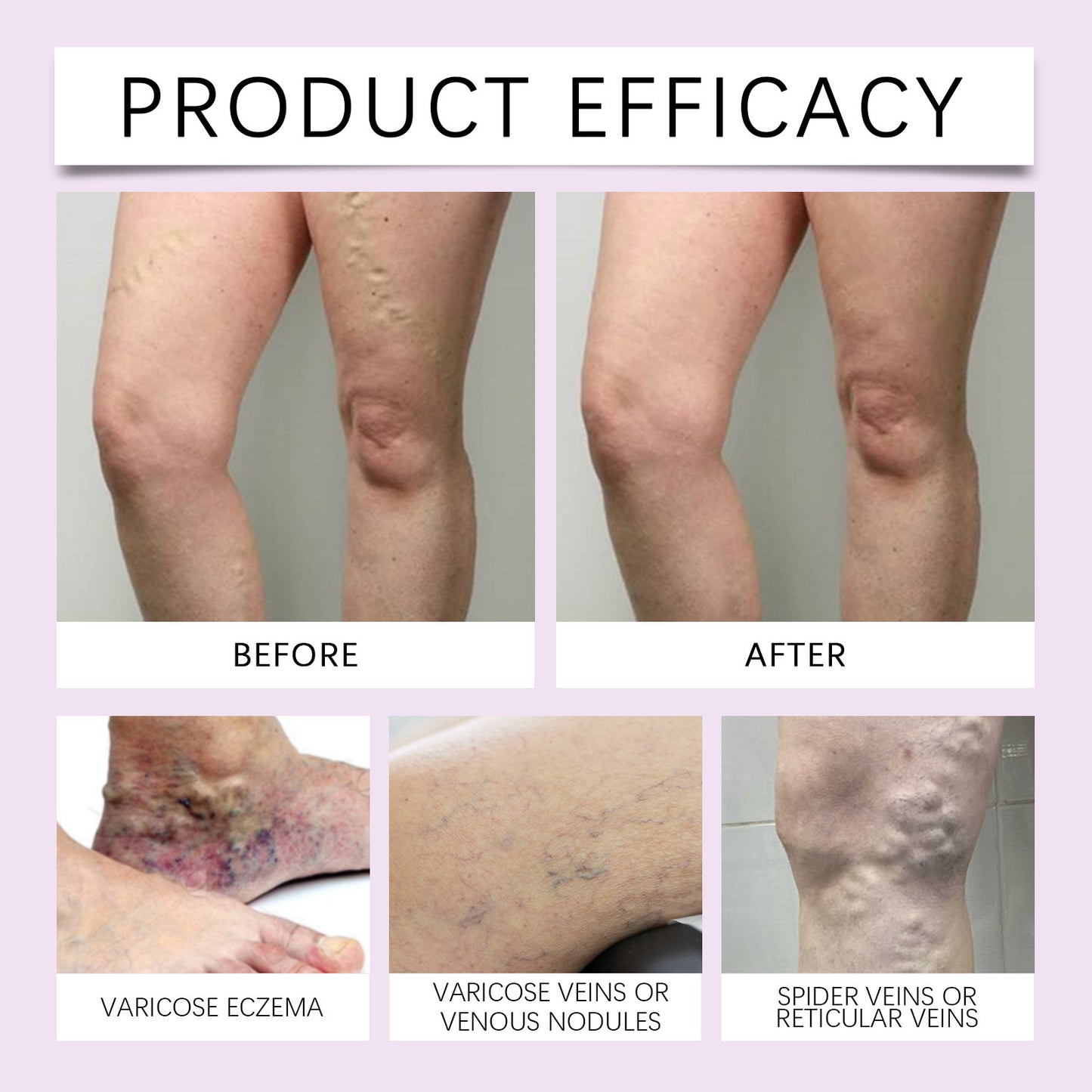 XIMONTH vein repair cream relieves leg swelling earthworm leg varicose vein massage body care cream